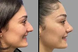 Is Nose Surgery Dubai Suitable Option?
