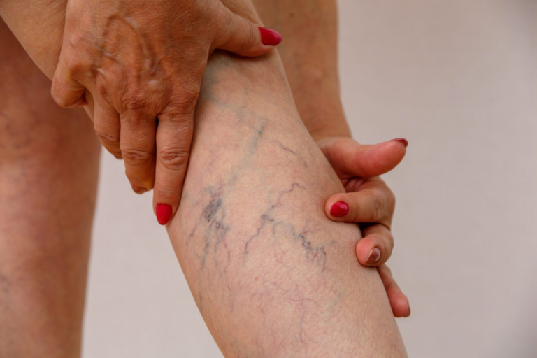 Is There a Permanent Treatment for Varicose Veins? Find Out
