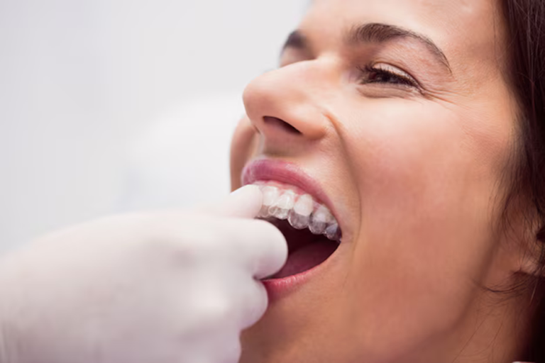 Top Tips for Getting Invisalign in Los Angeles Without Regret